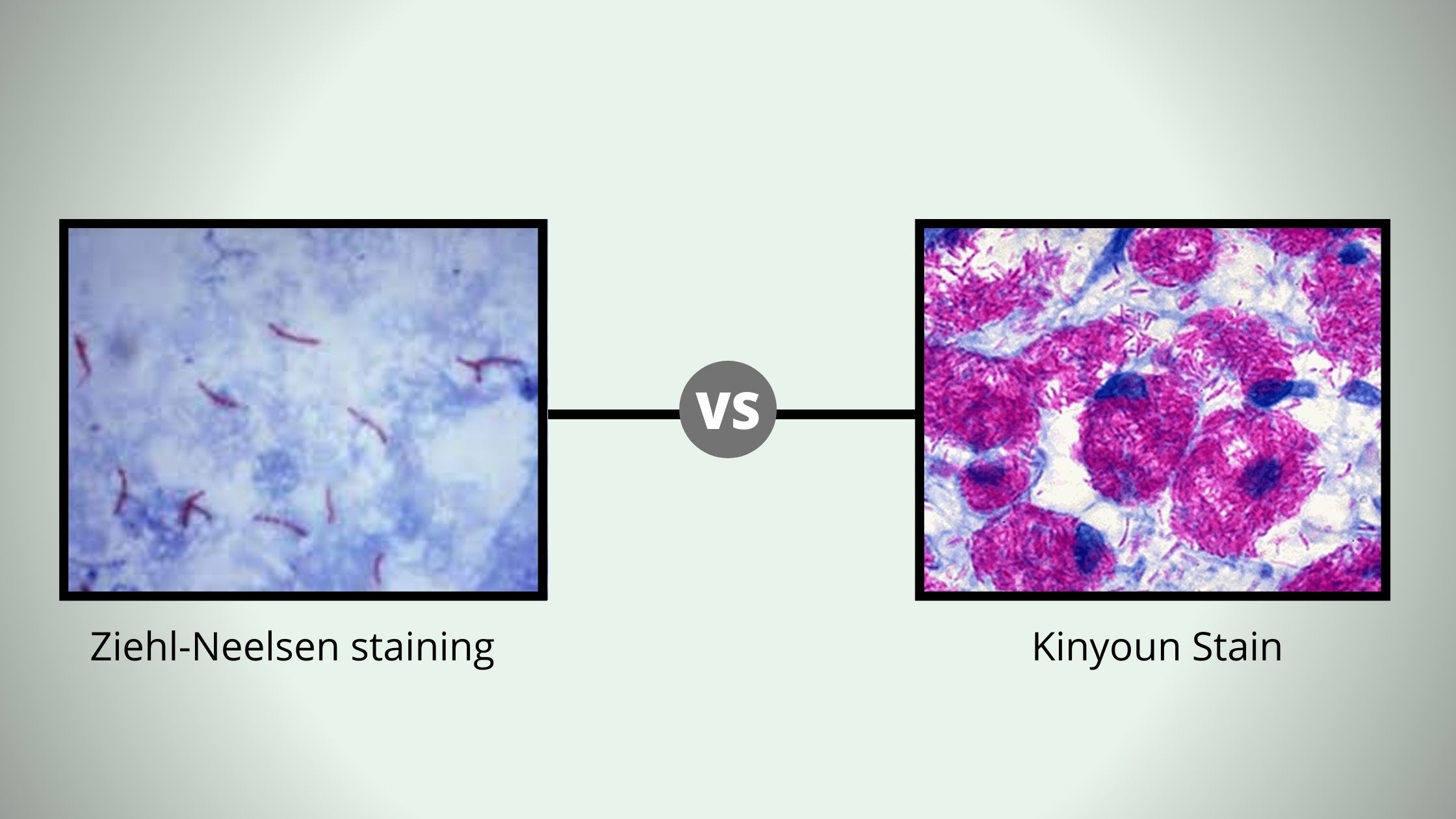 Comparison Between Kinyoun Stain vs Ziehl neelsen staina