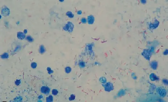 Result of Ziehl-Neelsen Staining or acid-fast staining