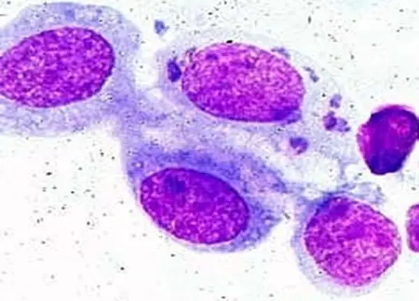 Giemsa Staining Photograph showing epithelial cells of conjunctiva containing intra-cytoplasmic inclusions “draped” around nucleus (source)
