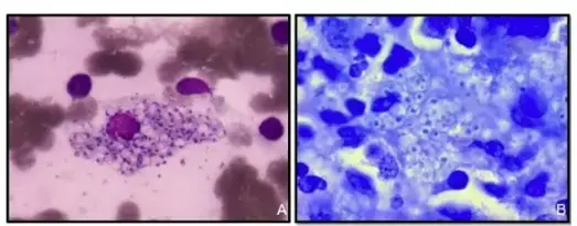 Histoplasma capsulatum within histiocytes seen on bone marrow biopsy staining: (A) Wright–Giemsa and (B) Giemsa
