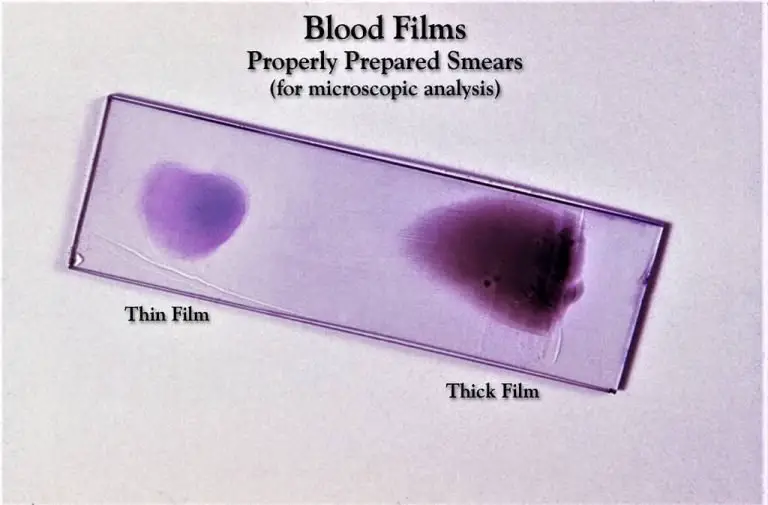 THIN AND THICK BLOOD SMEAR ON THE SAME SLIDE
