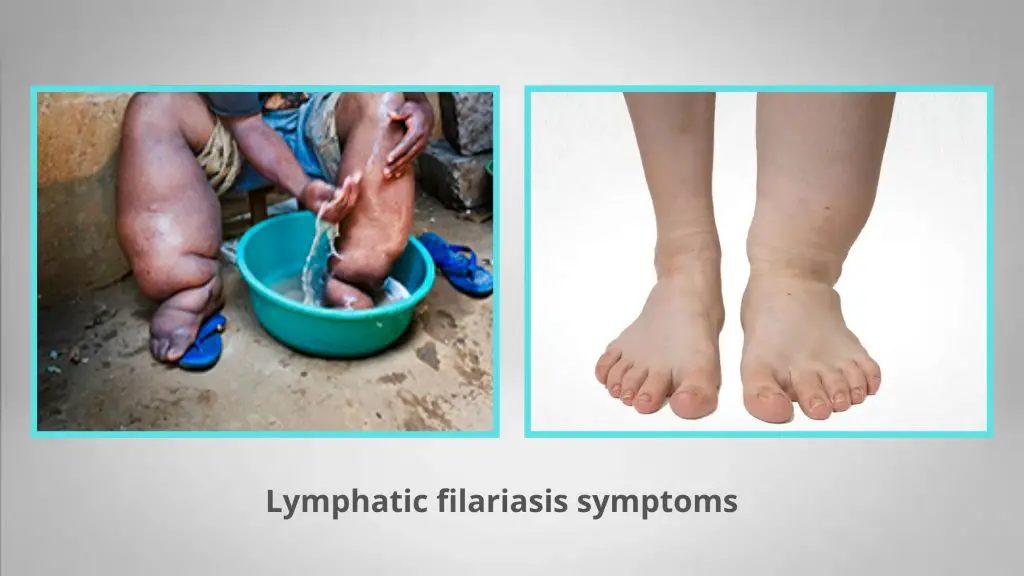 Lymphatic filariasis symptoms