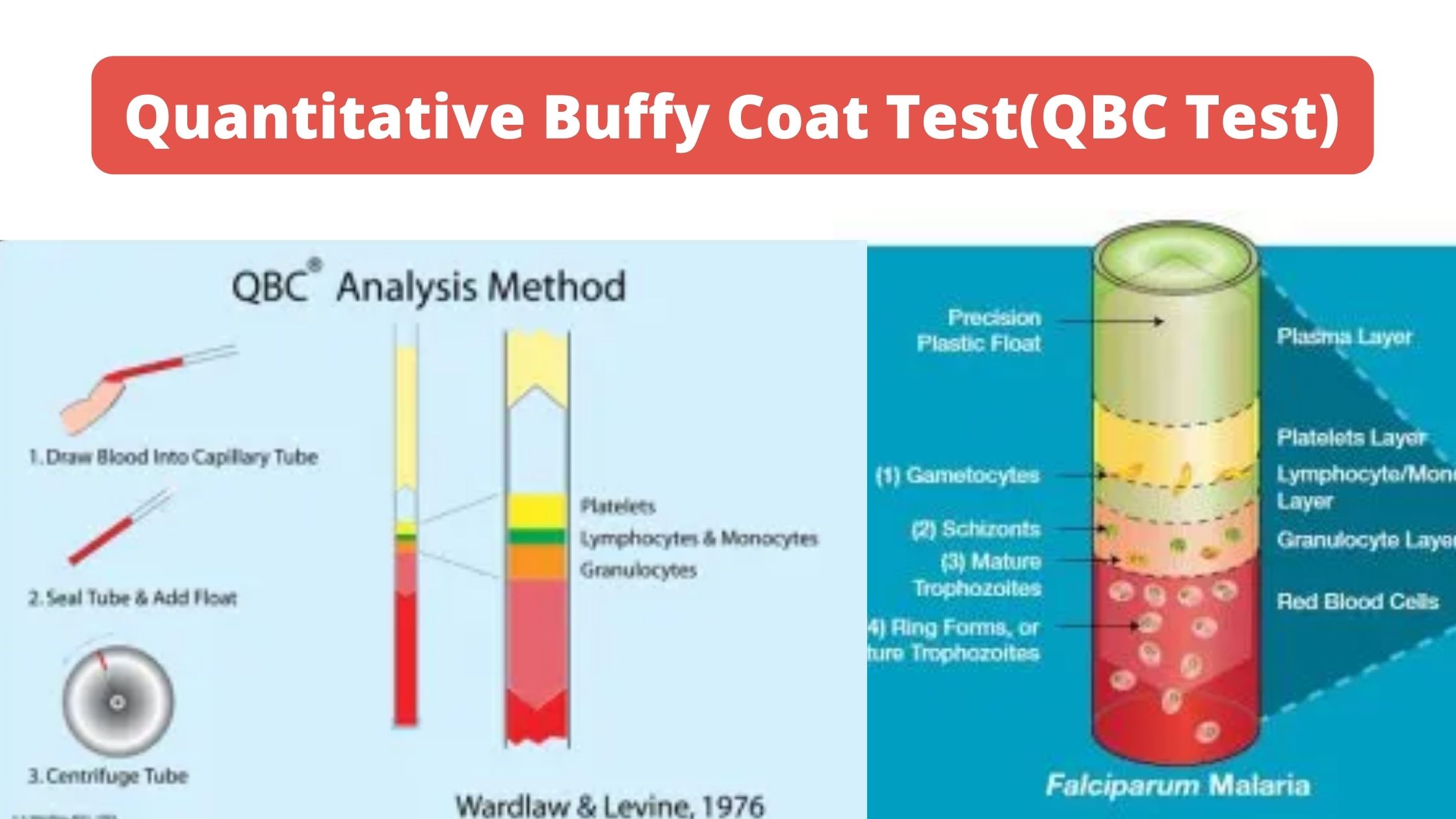 Quantitative Buffy Coat Test(QBC Test)