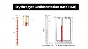 Erythrocyte Sedimentation Rate (ESR): Principle, Methods
