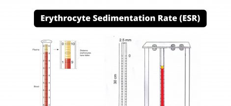 Erythrocyte Sedimentation Rate (ESR): Principle, Methods