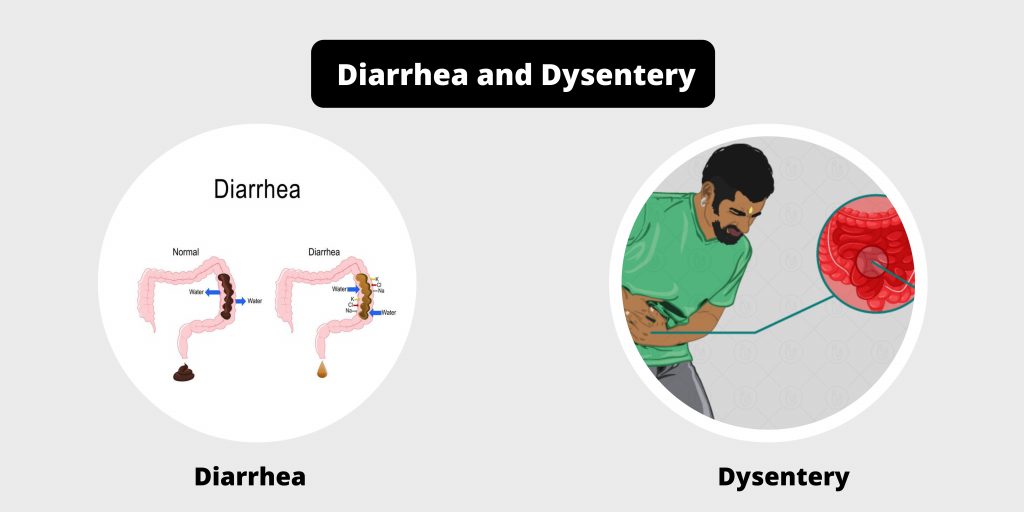 Differences between Diarrhea and Dysentery - Diarrhea vs Dysentery