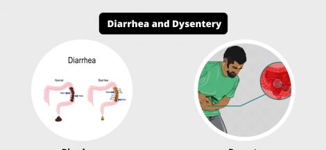 Differences between Diarrhea and Dysentery - Diarrhea vs Dysentery