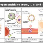 Hypersensitivity Type I, II, III and IV- Summary in table form