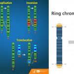 Chromosome Abnormalities Types, Mechanism, Detection