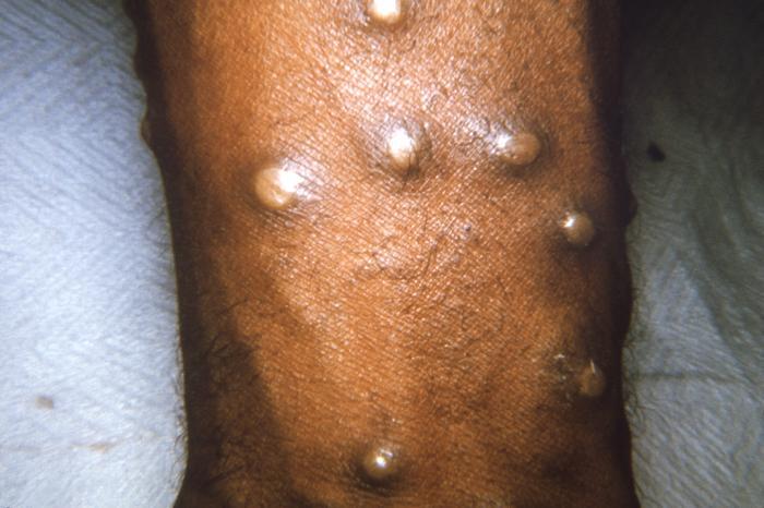 Monkeypox virus symptoms