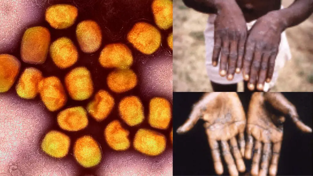 Monkeypox Virus - Pictures, Structure, Classification, Prevention, Treatment, Spread
