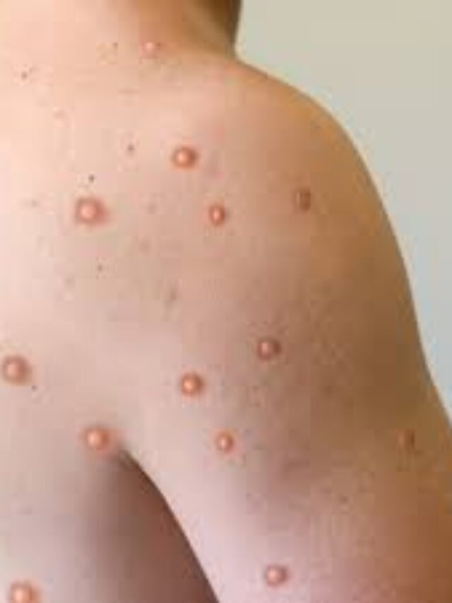 Key Facts About Monkeypox