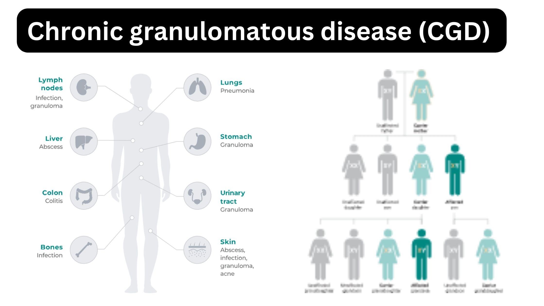 Chronic granulomatous disease (CGD) 