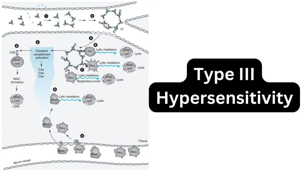 Type III Hypersensitivity