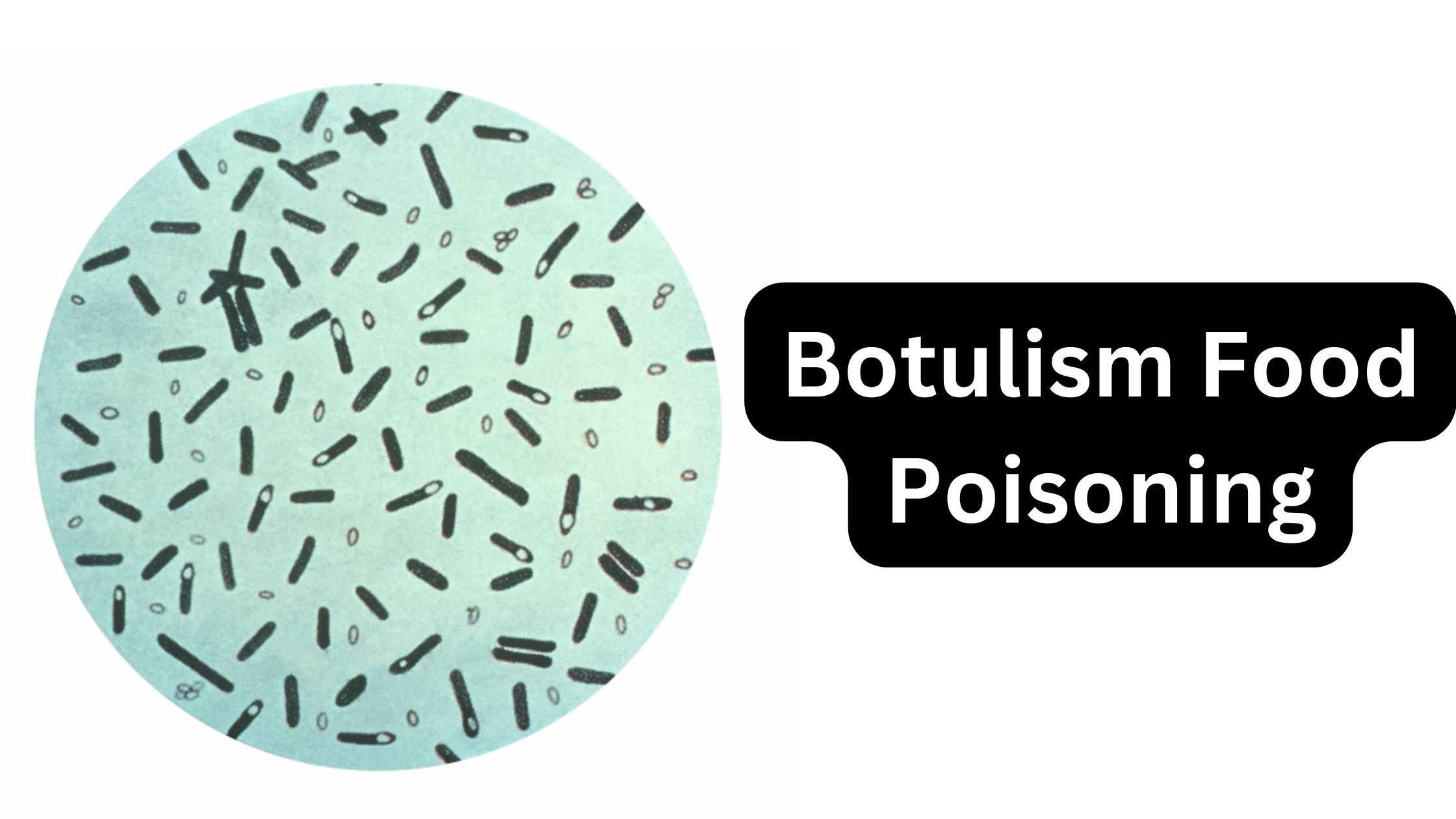 Botulism Food Poisoning