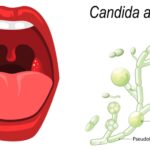 Candidiasis - Types, Causative Agent, Treatment, Prevention, Symptoms
