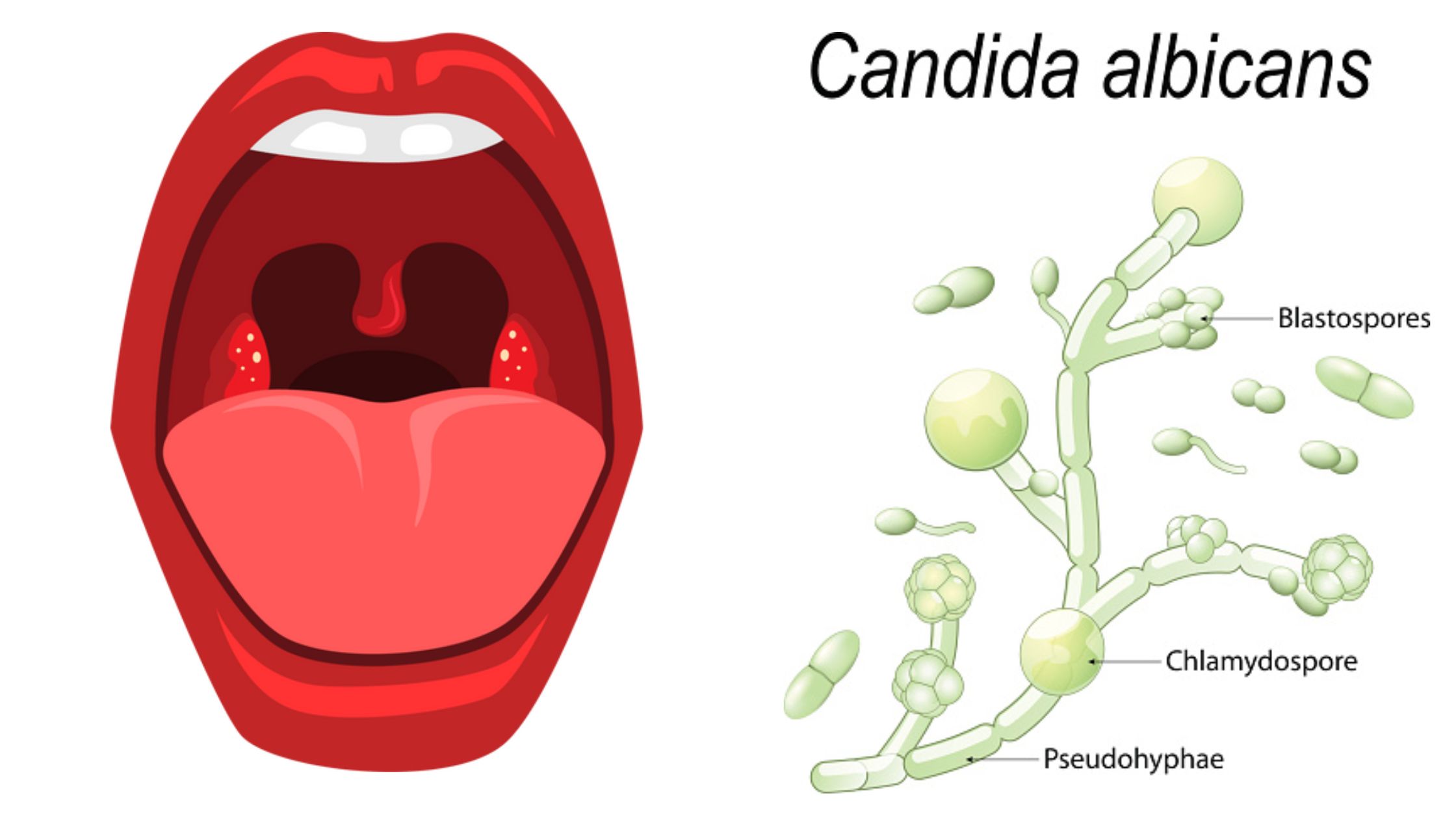 Candidiasis - Types, Causative Agent, Treatment, Prevention, Symptoms