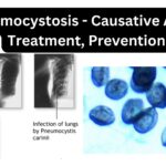 Pneumocystosis - Causative Agent, Treatment, Prevention