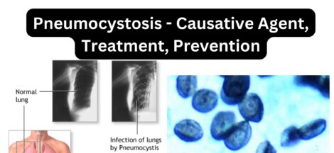 Pneumocystosis - Causative Agent, Treatment, Prevention