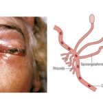Zygomycosis (Mucormycosis) - Causative Agent, Symptoms, Prevention, Treatment