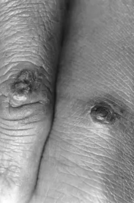 Umbilicated nodular lesions over the finger and wrist—milker’s
nodules (Courtesy: Thappa DM. Textbook of Dermatology, Venereology and
Leprology. 2nd ed. India: Elsevier; 2005, p. 76, Fig. 7.12.).