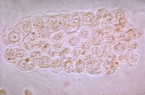 Renal Tubular Epithelial Cell Casts
