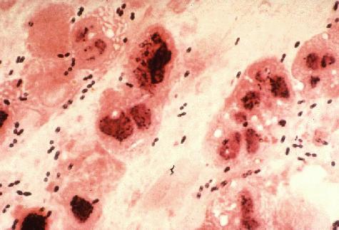 Gram Stain of a film of sputum from a case of lobar pneumonia. CDC.

