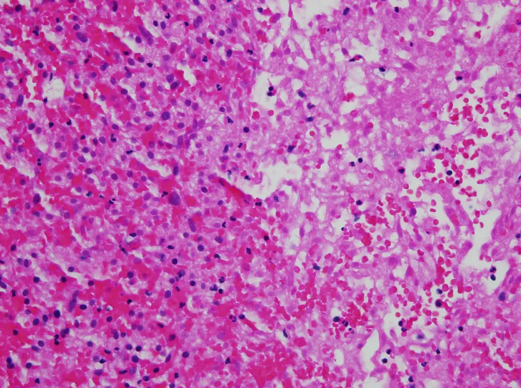 Cytoplasmic hypereosinophilia (seen in left half of image)

