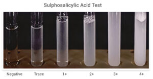 Sulphosalicylic Acid Test for Proteinuria: Principle, Procedure, Result, Uses