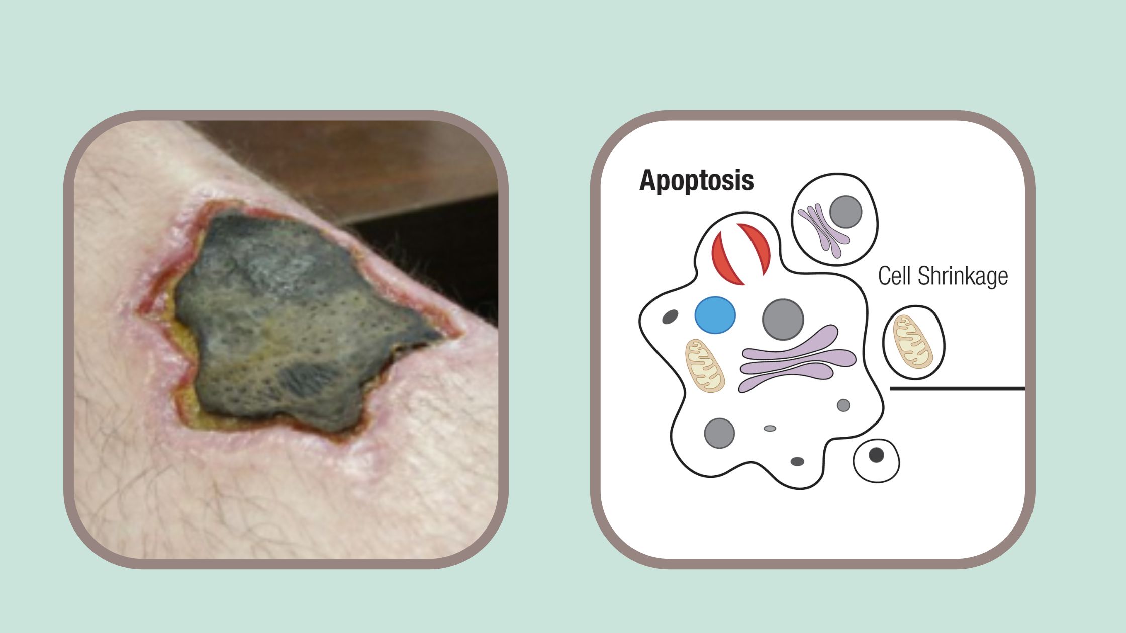 Apoptosis vs. Necrosis - Definition, Types, Causes