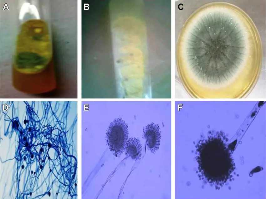(A) Obverse view of Aspergillus flavus on Sabouraud dextrose agar (SDA) culture tube; (B) reverse view of A. flavus on potato dextrose agar (PDA) culture tube; (C) 10Â microscopic view of A. flavus with lactophenol cotton blue (LCB) stain; (D) 40Â microscopic view of A. flavus with LCB stain; (E) 100Â microscopic view of A. flavus with LCB stain; (F) growth of A. flavus on PDA.  
