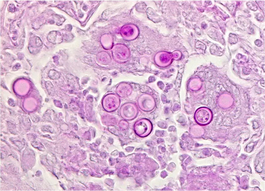 Blastomyces dermatitidis organisms are characterized by thick cell walls, formation of a single broad-based bud, and multiple nuclei. (PAS stained)
