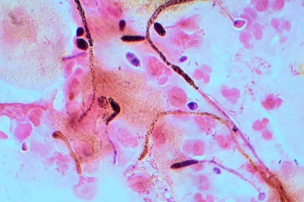 Candida albicans visualized by Gram stain and microscopy. Note the hyphae and chlamydospores, which are 2–4 µm in diameter.