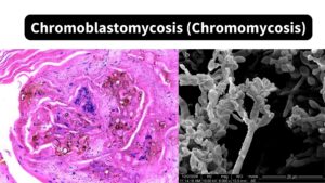 Chromoblastomycosis (Chromomycosis) - Morphology, Pathogenesis, Transmission, Treatment