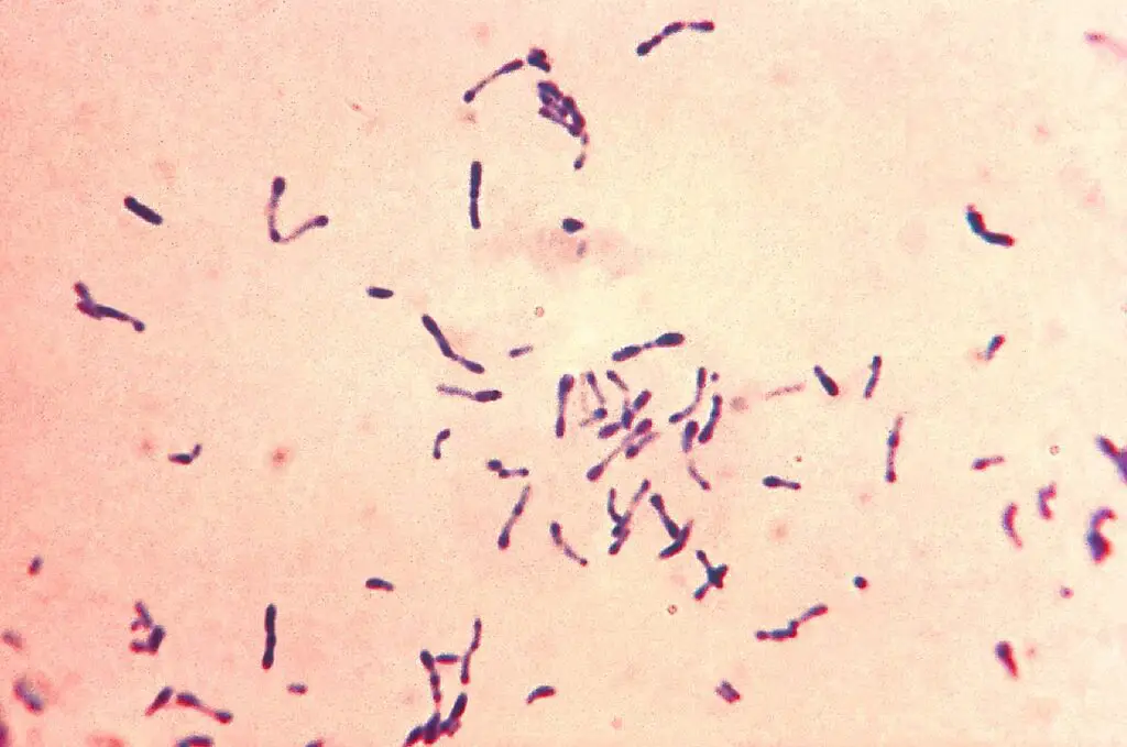 This photomicrograph displayed a number of methylene blue-stained Gram-positive Corynebacterium diphtheriae bacteria. The sample was collected from a Pai's oblique culture. Diphtheria is an acute bacterial infection induced by toxigenic strains of Corynebacterium diphtheriae and, on occasion, C. ulcerans. The disease is transmitted via respiratory secretions and direct contact. Diphtheria affects the mucous membranes of the respiratory tract (known as "respiratory diphtheria"), the skin (known as "cutaneous diphtheria"), and occasionally other locations such as the eyes, nose, or va***a. Diphtheria continues to be a serious disease in the majority of the globe. In the 1990s, significant diphtheria outbreaks occurred throughout Russia and the other former Soviet republics. The majority of life-threatening cases occurred in unvaccinated individuals. Travelers to disease-endemic regions are more likely to be exposed to toxigenic C. diphtheriae strains.
