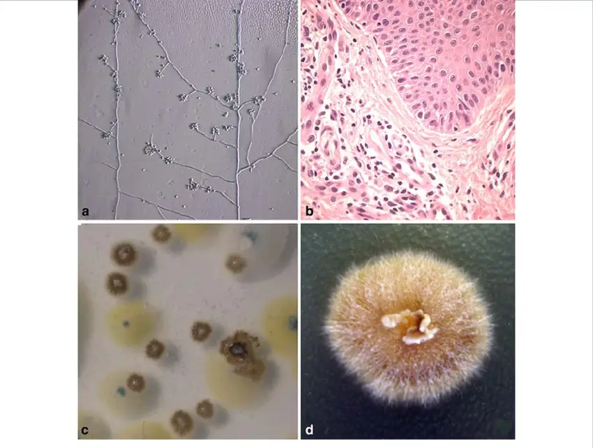 Microscopic and macroscopic morphologies of Sporothrix schenckii. (a) Branching mycelium with conidiophores (flower-like petals) and conidia (single and grouped); (b) Histopathology showed a granulomatous infiltrate with  
