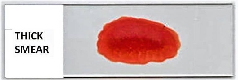 Thick Blood Smear
