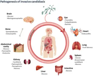Candidiasis - Definition, Causative Agent, Types, Transmission