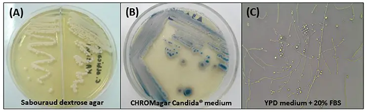 (A) Cream-colored, dull, smooth colonies, after 48 h of incubation at 30°C on Sabouraud dextrose agar; (B) Colonies with typical dark blue color on CHROMagar Candida® medium after 96 h of incubation at 35°C; (C) Micromorphological aspects after incubation in YPD medium containing 20% fetal bovine serum (FBS) for 7 days at 30°C, 400x: blastoconidia in single or branched chains, true hyphae and abundant pseudohyphae.