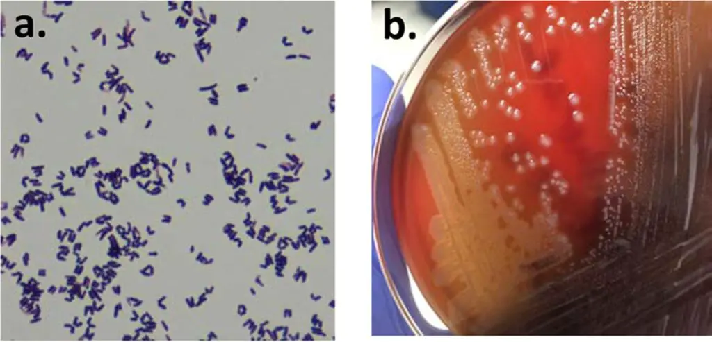 Gram stain and culture of the purified Corynebacterium diphtheriae isolate. (a) Gram stain revealed club-shaped Gram-positive rods, typical of Corynebacterium species. (b) Purified isolate producing a narrow zone of beta-hemolysis on sheep blood agar.