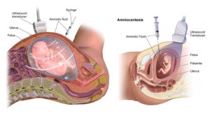 Amniocentesis (Amniotic Fluid Test) - Principle, Procedure, Result