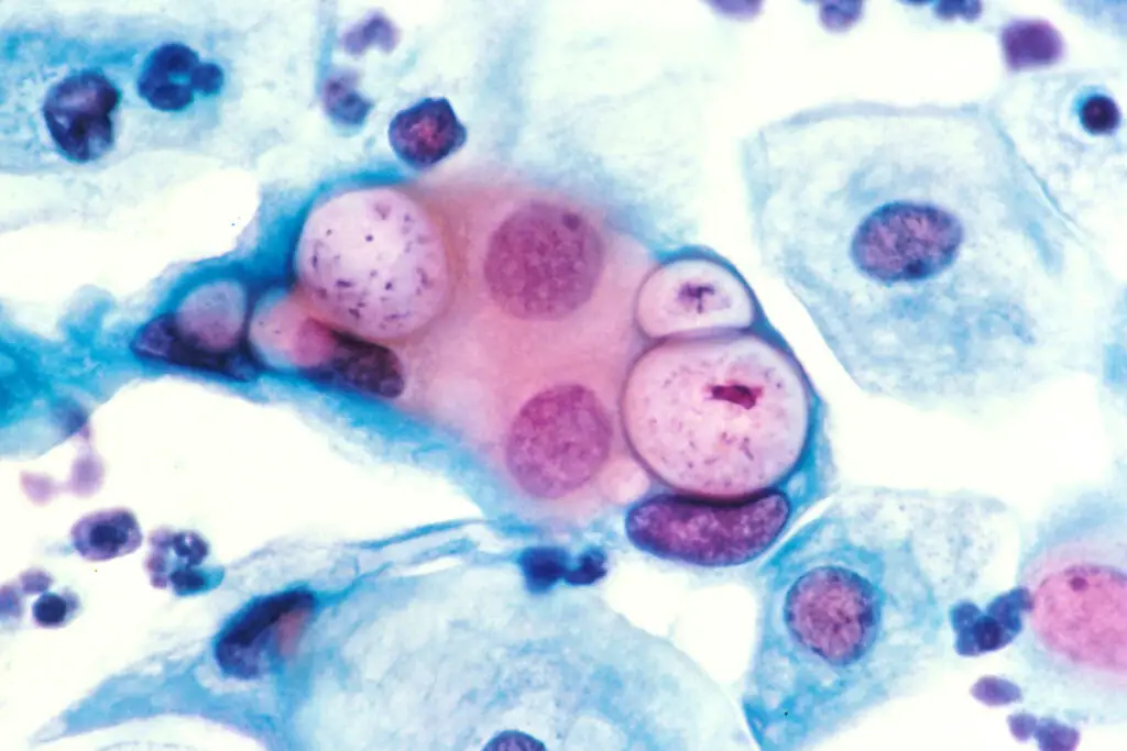 Pap smear showing clamydia in the vacuoles