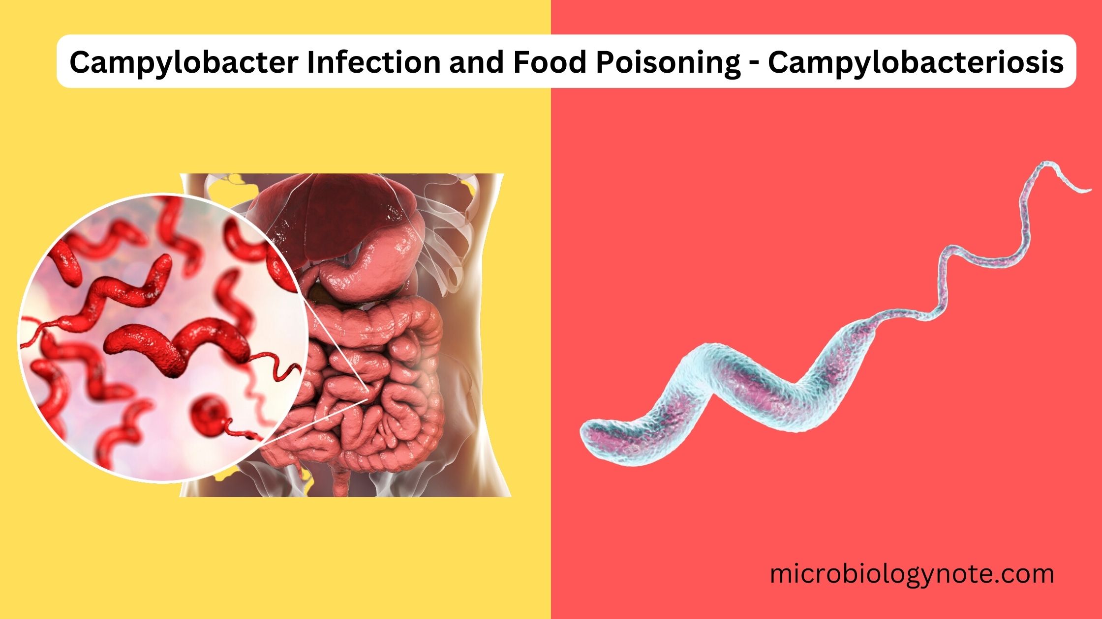 Campylobacter Infection and Food Poisoning - Campylobacteriosis