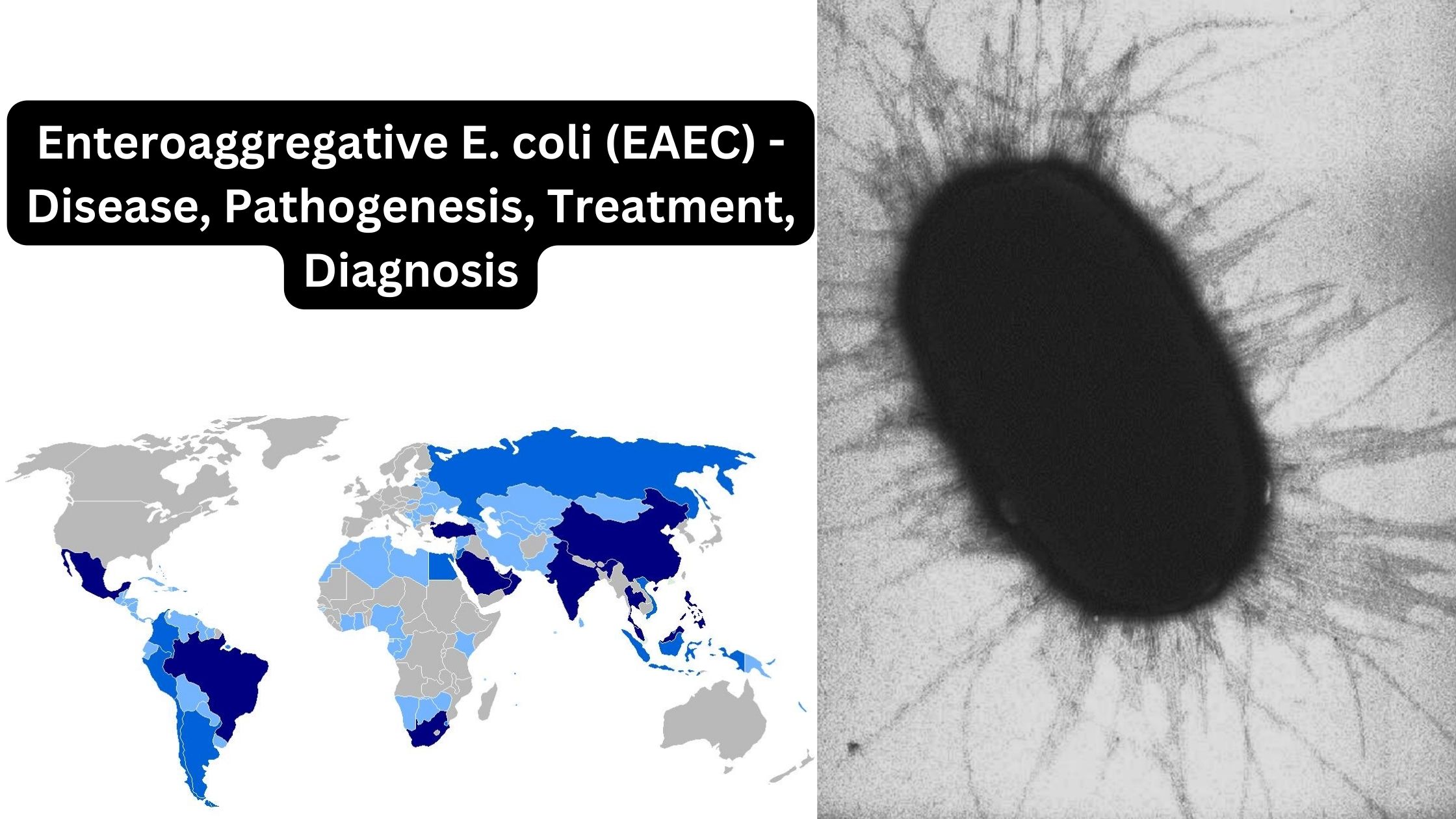 Enteroaggregative E. coli (EAEC) - Disease, Pathogenesis, Treatment, Diagnosis