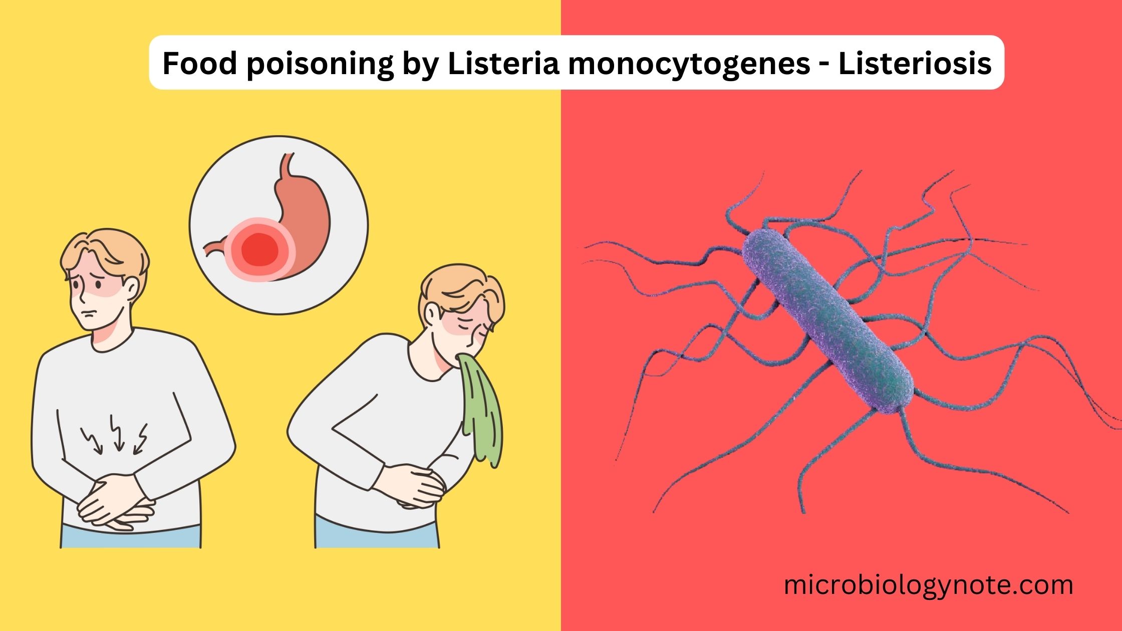 Food poisoning by Listeria monocytogenes - Listeriosis