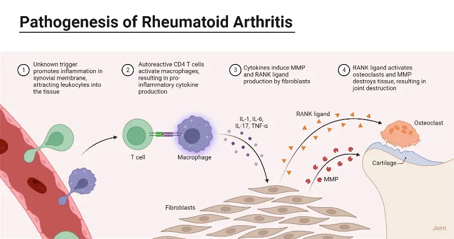 Pathogenesis of Rheumatoid Arthritis