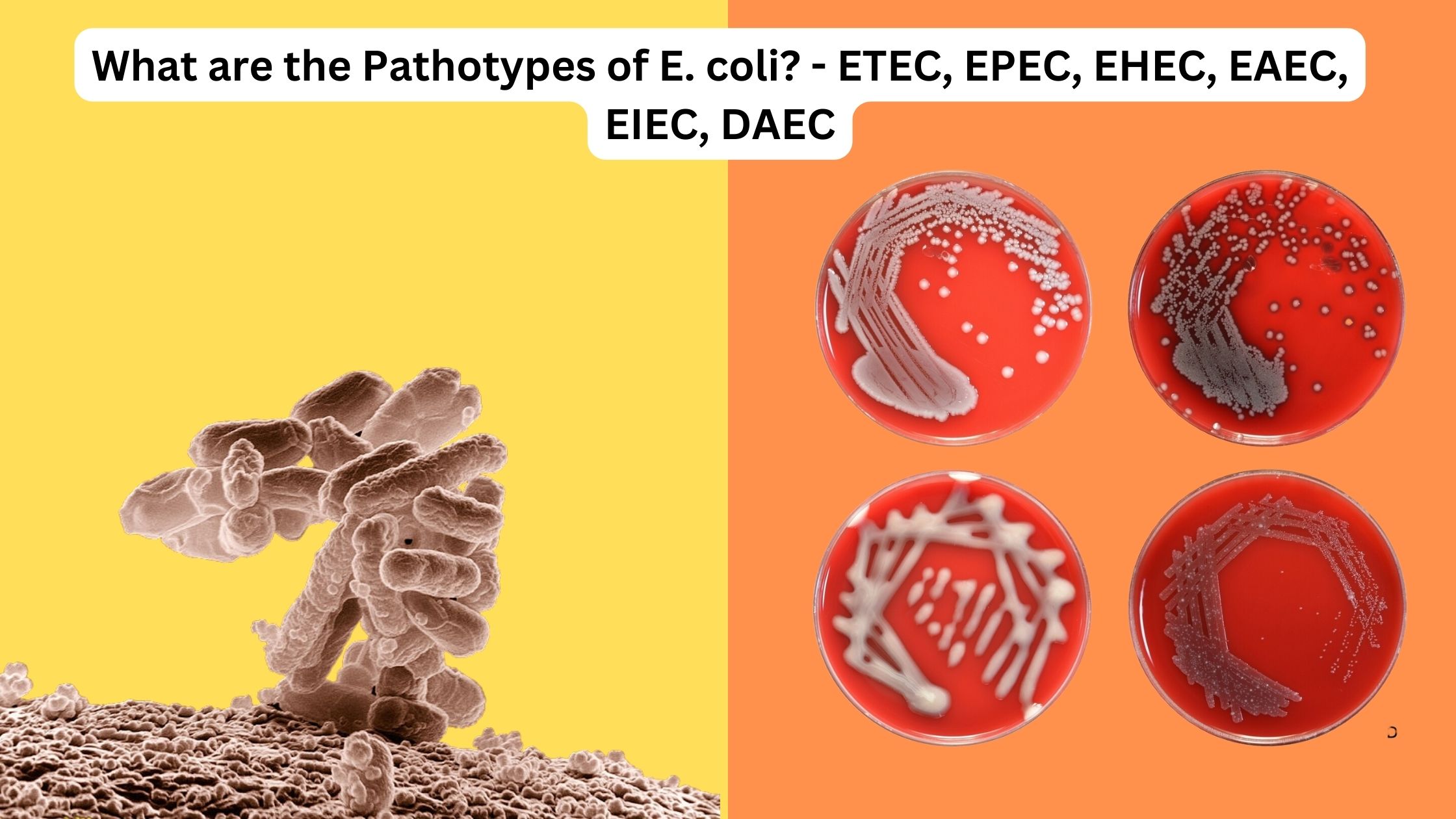 What are the Pathotypes of E. coli? - ETEC, EPEC, EHEC, EAEC, EIEC, DAEC