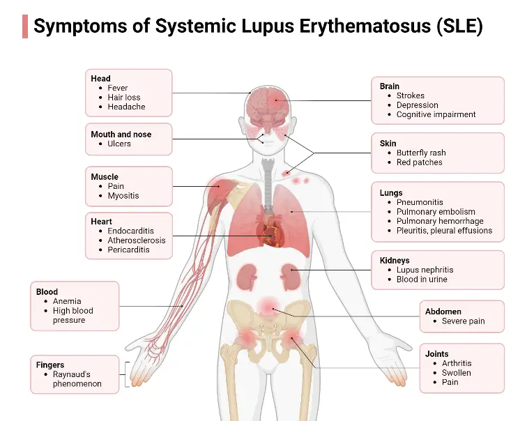 Symptoms of Systemic Lupus Erythematosus (SLE)