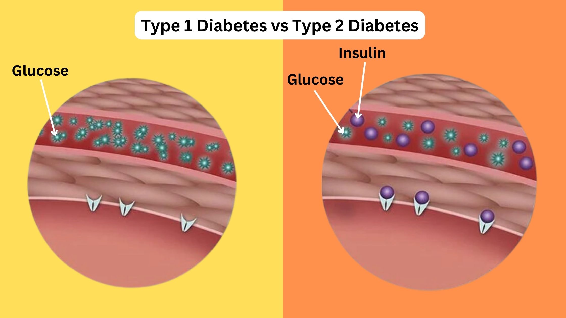 Type 1 Diabetes vs Type 2 Diabetes