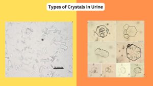 Types of Crystals in Urine